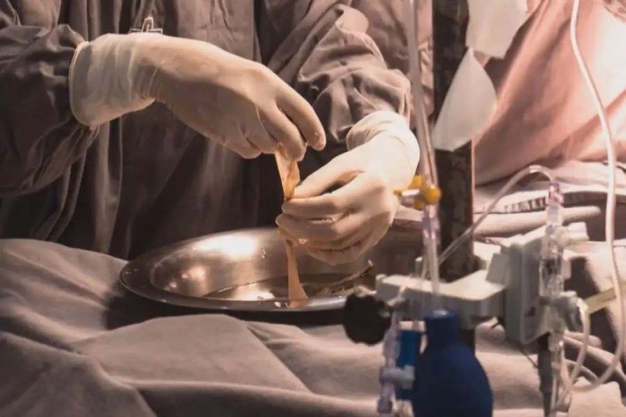 Menino com 60% do corpo queimado recebe pele de doadores em procedimento inédito em MS