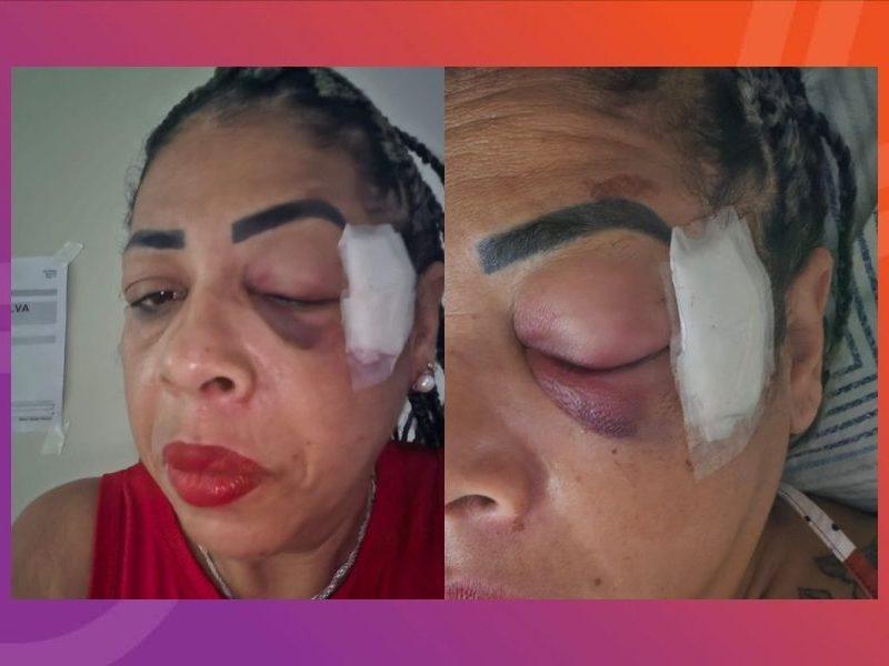Servidora pública tem fraturas na face após ser atropelada em comemoração à vitória de Lula em Cáceres
